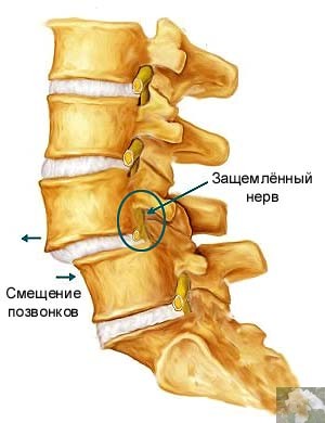 Боль в пояснице 